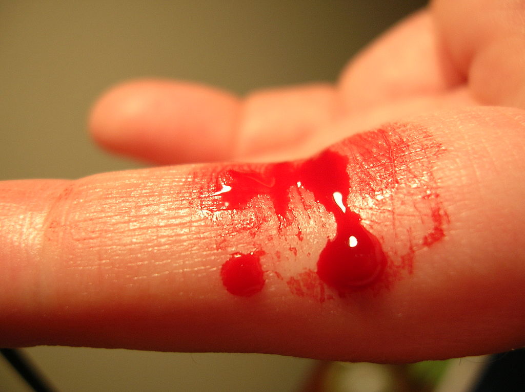 Bleeding finger.